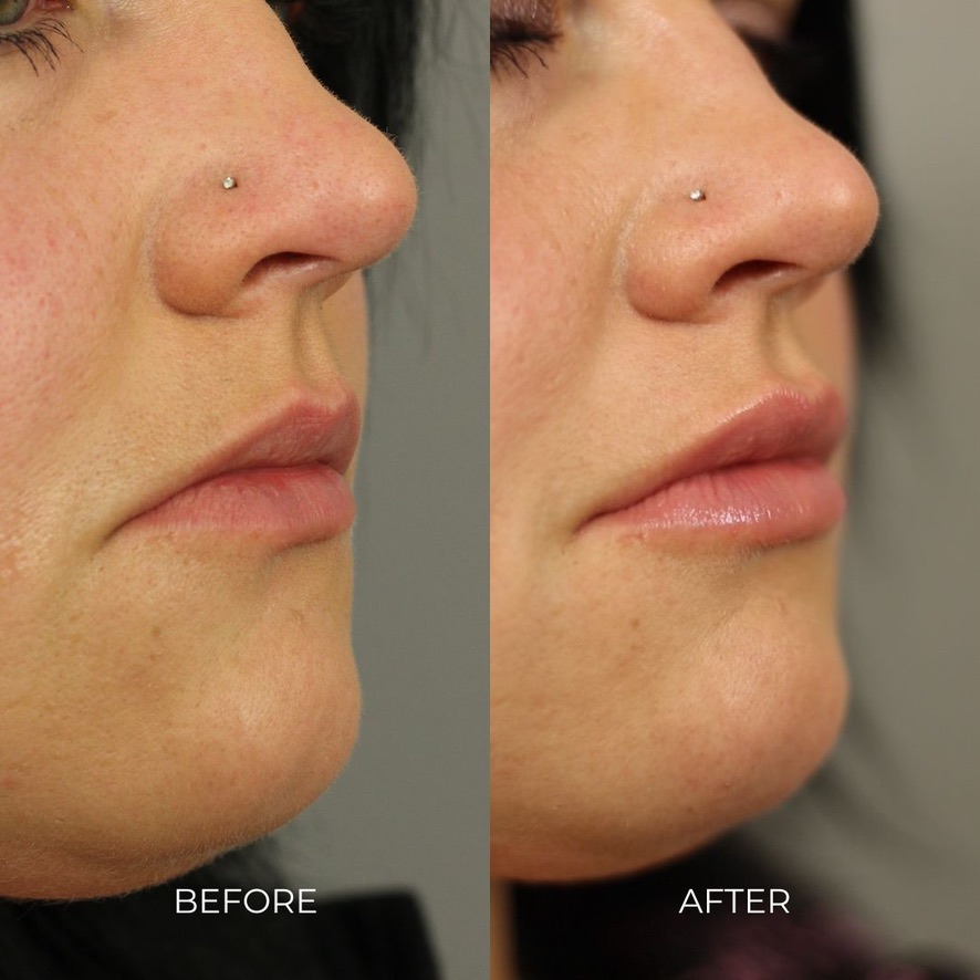 Do Fillers Stretch Out Your Skin?