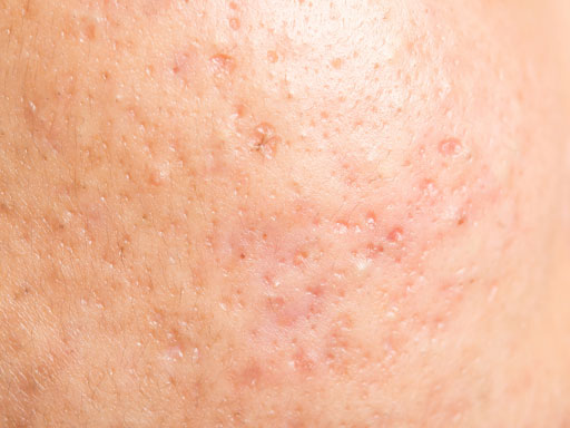 Boxcar acne scar