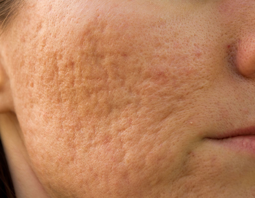 dayton ohio acne scar treatment
