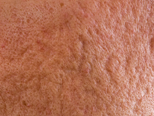 Rolling acne scar