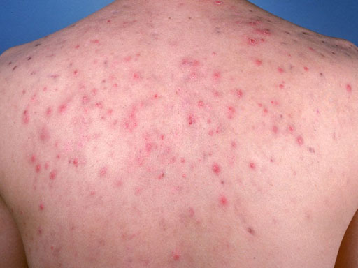 DEEP, LARGE, RED PAINFUL ACNE BUMPS